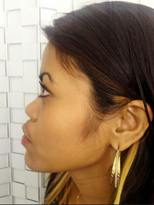 Before & After images - Nose jobs for Asians