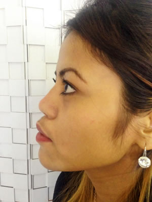 Before & After images - Nose jobs for Asian woman