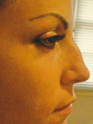 Before & After images - Non-Surgical rhinoplasty Sydney