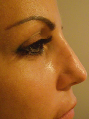 Before & After images - Nose jobs - Non-surgical Rhinoplasty by Dr Sydney Clinic