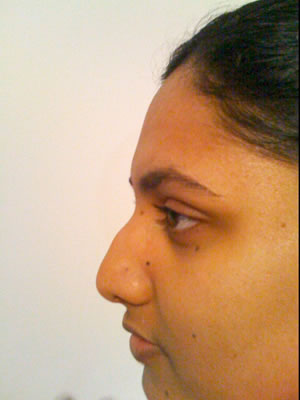 Before & After images - Non-Surgical rhinoplasty for Asian woman