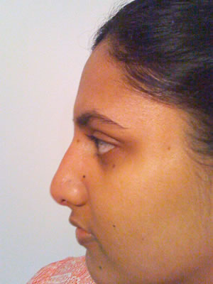 Before & After images - Non-Surgical rhinoplasty for Asian woman Sydney