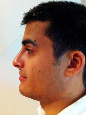 Before & After images - Nose jobs for men Sydney